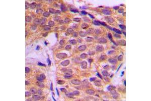 Immunohistochemical analysis of YAP1 staining in human breast cancer formalin fixed paraffin embedded tissue section.