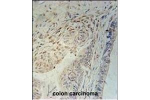 CCD92 Antibody (Center) (ABIN651208 and ABIN2840130) immunohistochemistry analysis in formalin fixed and paraffin embedded human colon carcinoma followed by peroxidase conjugation of the secondary antibody and DAB staining. (CCDC92 抗体  (AA 177-205))