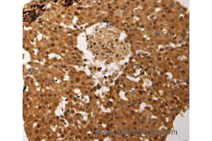 Immunohistochemistry of Human breast cancer using JUND Polyclonal Antibody at dilution of 1:60 (JunD 抗体)