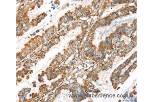 Immunohistochemistry of Human esophagus cancer using LOXL4 Polyclonal Antibody at dilution of 1:35 (LOXL4 抗体)