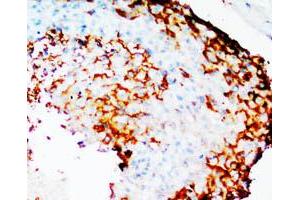 Immunohistochemical staining of PTGS2 on formalin fixed, paraffin embedded human mammary cancer with PTGS2 polyclonal antibody . (PTGS2 抗体  (N-Term))