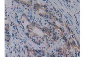 Detection of PKBb in Human Stomach cancer Tissue using Polyclonal Antibody to Protein Kinase B Beta (PKBb) (AKT2 抗体  (AA 142-412))