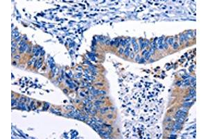 The image on the left is immunohistochemistry of paraffin-embedded Human colon cancer tissue using ABIN7193124(Gjc3 Antibody) at dilution 1/10, on the right is treated with synthetic peptide. (GJC3 抗体)