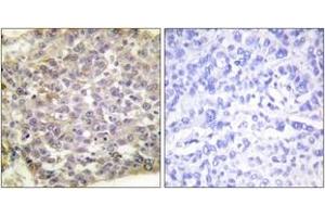 Immunohistochemistry analysis of paraffin-embedded human breast carcinoma tissue, using 14-3-3 zeta (Ab-58) Antibody. (14-3-3 zeta 抗体  (AA 24-73))