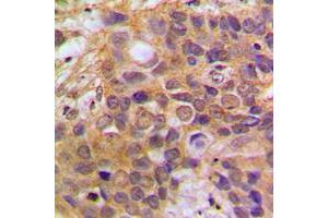 Immunohistochemical analysis of DAXX staining in human breast cancer formalin fixed paraffin embedded tissue section. (DAXX 抗体  (Center))