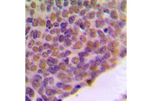 Immunohistochemical analysis of BRCA1 staining in human breast cancer formalin fixed paraffin embedded tissue section.