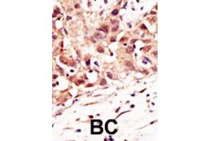 Formalin-fixed and paraffin-embedded human cancer tissue reacted with the primary antibody, which was peroxidase-conjugated to the secondary antibody, followed by DAB staining. (SENP5 抗体  (C-Term))