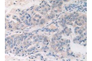 IHC-P analysis of Human Breast Cancer Tissue, with DAB staining. (FDFT1 抗体  (AA 269-417))