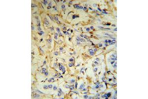 FGA Antibody (RB18707) IHC analysis in formalin fixed and paraffin embedded human breast carcinoma tissue followed by peroxidase conjugation of the secondary antibody and DAB staining. (FGA 抗体  (N-Term))