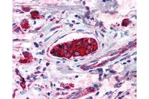 Anti-CNR2 / CB2 antibody IHC of human Breast, Carcinoma. (CNR2 抗体  (Cytoplasmic Domain))