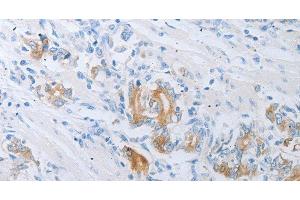 Immunohistochemistry of paraffin-embedded Human gastric cancer using LOX Polyclonal Antibody at dilution of 1:30 (LOX 抗体)