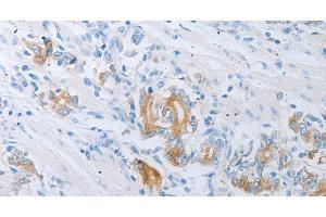 Immunohistochemistry of paraffin-embedded Human gastric cancer using LOX Polyclonal Antibody at dilution of 1:30 (LOX 抗体)