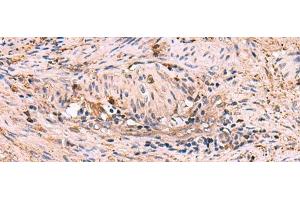 Immunohistochemistry of paraffin-embedded Human cervical cancer tissue using MAPK8IP3 Polyclonal Antibody at dilution of 1:45(x200) (JIP3 抗体)
