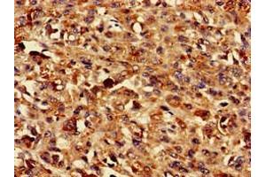 Immunohistochemistry of paraffin-embedded human melanoma using ABIN7173215 at dilution of 1:100 (TMEM43 抗体  (AA 178-312))