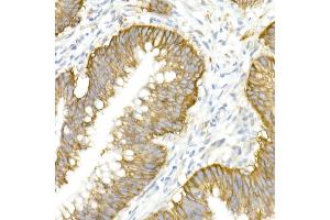 Immunohistochemistry of paraffin-embedded human colon carcinoma using SLC12 Rabbit pAb (ABIN6131136, ABIN6147843, ABIN6147844 and ABIN6215366) at dilution of 1:50 (40x lens). (SLC12A2 抗体  (AA 120-280))
