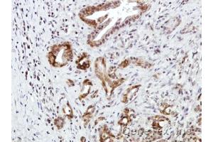 IHC-P Image Immunohistochemical analysis of paraffin-embedded Human pancreatic tumor, using CXCR7, antibody at 1:100 dilution. (CXCR7 抗体)