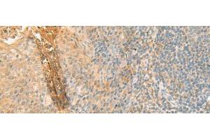 Immunohistochemistry of paraffin-embedded Human tonsil tissue using GPT2 Polyclonal Antibody at dilution of 1:70(x200) (GPT2 抗体)