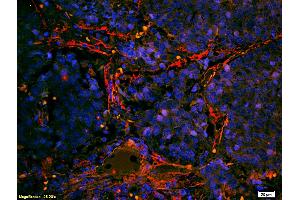 Formalin-fixed and paraffin embedded human lung carcinoma labeled with Anti- Integrin alpha 7/ITGA7 Polyclonal Antibody, Unconjugated (ABIN734858) at 1:200 followed by conjugation to the secondary antibody Goat Anti-Rabbit IgG, Cy3 conjugated used at 1:200 dilution for 40 minutes at 37°C (ITGA7 抗体  (AA 701-800))