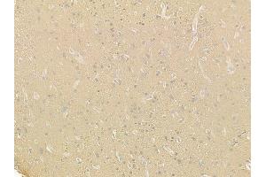 ABIN6257616 and ABIN6275245 at 1/100 staining human glioblastoma by IHC-P.