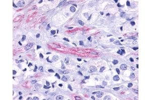 Anti-GPR124 / TEM5 antibody IHC of human Prostate, Carcinoma Endothelial Cells. (GPR124 抗体  (N-Term))