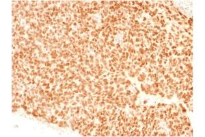 Formalin-fixed, paraffin-embedded human Ewing's Sarcoma stained with NKX2.