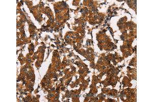 Immunohistochemistry of Human thyroid cancer using ATRN Polyclonal Antibody at dilution of 1:50 (Attractin 抗体)