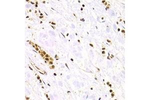 Immunohistochemistry of paraffin-embedded human gastric cancer using RAD50 Antibody. (RAD50 抗体)