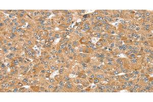 Immunohistochemistry of paraffin-embedded Human liver cancer using MORF4L1 Polyclonal Antibody at dilution of 1:35 (MORF4L1 抗体)