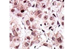 IHC analysis of FFPE human cancer tissue stained with the AXL antibody (AXL 抗体  (AA 13-44))