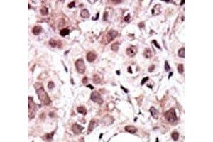 IHC analysis of FFPE human cancer tissue stained with the AXL antibody