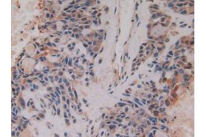 IHC-P analysis of Human Lung Cancer Tissue, with DAB staining. (CKMT1A 抗体  (AA 41-250))