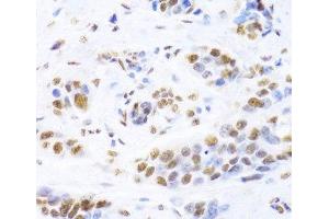Immunohistochemistry of paraffin-embedded Human breast cancer using XRCC5 Polyclonal Antibody at dilution of 1:100 (40x lens). (XRCC5 抗体)