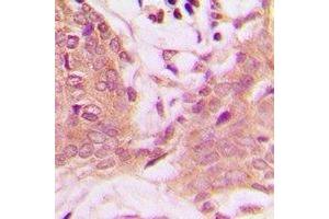 Immunohistochemical analysis of PEA15 (pS116) staining in human breast cancer formalin fixed paraffin embedded tissue section. (PEA15 抗体  (C-Term, pSer116))