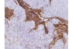 Immunohistochemistry (Paraffin-embedded Sections) (IHC (p)) image for anti-Carcinoembryonic Antigen-Related Cell Adhesion Molecule 5 (CEACAM5) antibody (ABIN192374)