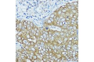 Immunohistochemistry of paraffin-embedded human breast cancer using BSCL2 antibody (ABIN7265874) at dilution of 1:100 (40x lens). (BSCL2 抗体  (AA 50-150))