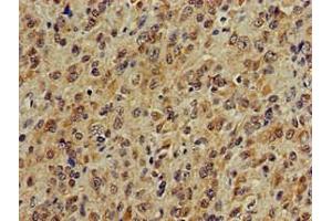Immunohistochemistry of paraffin-embedded human glioma using ABIN7142041 at dilution of 1:100 (Phospholipase C beta 1 抗体  (AA 781-896))