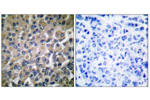 Immunohistochemical analysis of paraffin-embedded human breast carcinoma tissue, using GRP78 antibody (ABIN5976417). (GRP78 抗体  (C-Term))