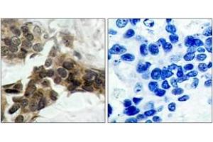 Immunohistochemistry analysis of paraffin-embedded human breast carcinoma, using IkappaB-alpha (Phospho-Ser32/Ser36) Antibody. (NFKBIA 抗体  (pSer32))