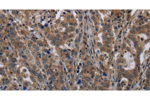 Immunohistochemistry of paraffin-embedded Human liver cancer tissue using TSC22D3 Polyclonal Antibody at dilution 1:40 (TSC22D3 抗体)