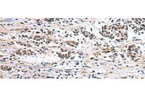 Immunohistochemistry of paraffin-embedded Human breast cancer tissue using CLCN7 Polyclonal Antibody at dilution of 1:105(x200) (CLCN7 抗体)