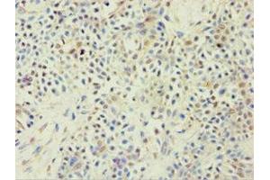 Immunohistochemistry of paraffin-embedded human breast cancer using ABIN7144925 at dilution of 1:100 (ABCF2 抗体  (AA 1-250))