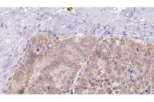 ABIN6273340 at 1/100 staining Human thyroid cancer tissue by IHC-P. (UQCRQ 抗体  (Internal Region))