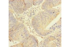 Immunohistochemistry of paraffin-embedded human colon cancer using ABIN7167451 at dilution of 1:100 (REEP5 抗体  (AA 120-189))