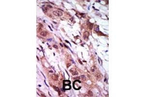 Formalin-fixed and paraffin-embedded human cancer tissue reacted with the primary antibody, which was peroxidase-conjugated to the secondary antibody, followed by AEC staining. (Aurora Kinase C 抗体  (C-Term))