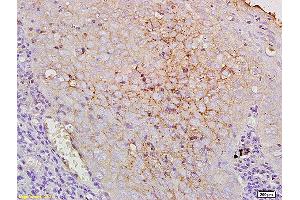 Formalin-fixed and paraffin human laryngocarcinoma labeled with Anti-CD44V10 Polyclonal Antibody, Unconjugated at 1:200, followed by conjugation to the secondary antibody and DAB staining. (CD44v10 (AA 218-227) 抗体)