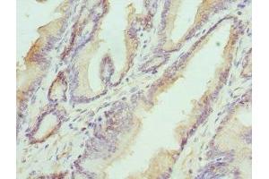 Immunohistochemistry of paraffin-embedded human prostate cancer using ABIN7155947 at dilution of 1:100 (HAPLN1 抗体  (AA 165-354))