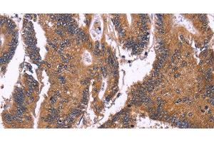 Immunohistochemistry of paraffin-embedded Human colon cancer using SEPT7 Polyclonal Antibody at dilution of 1:50 (Septin 7 抗体)