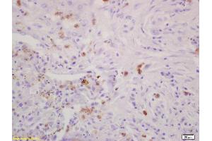 Formalin-fixed and paraffin embedded human lung carcinoma labeled with Rabbit Anti CD79A/IGBP-1 Polyclonal Antibody, Unconjugated (ABIN727578) at 1:200 followed by conjugation to the secondary antibody and DAB staining (IGBP1 抗体  (AA 151-250))