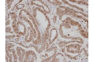 IHC-P Image Immunohistochemical analysis of paraffin-embedded human thyroid cancer, using CAMK1D , antibody at 1:100 dilution. (CAMK1D 抗体)
