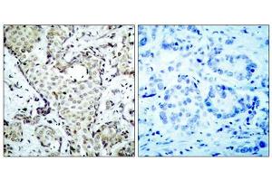 Immunohistochemical analysis of paraffin-embedded breast carcinoma, using MKK6 (epitope around residue 207) Antibody (ABIN5976227). (MAP2K3 抗体  (Ser207))